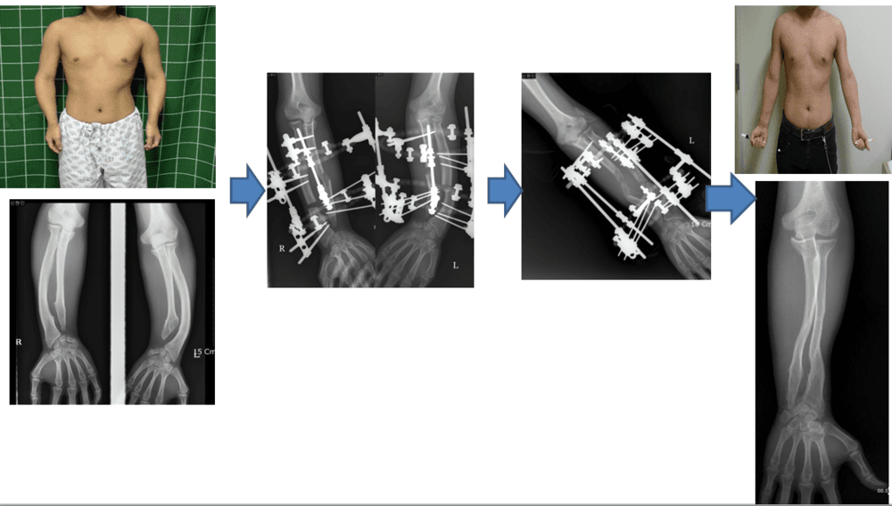 다발성연골종증환자의 상지변형교정