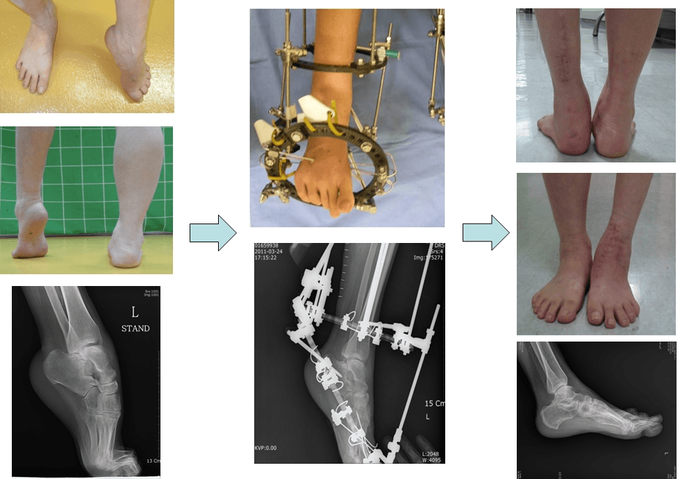 발의 변형에 대한 교정 3