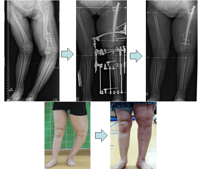 왼쪽다리에 변형이 온 소아마비 환자의 하지 교정술