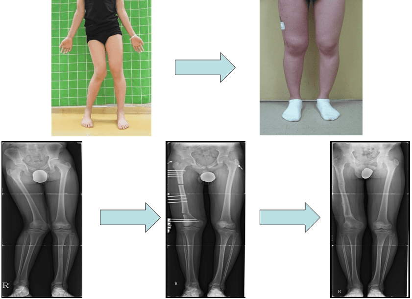 무릎관절손상후 발생한 하지변형에서의 교정