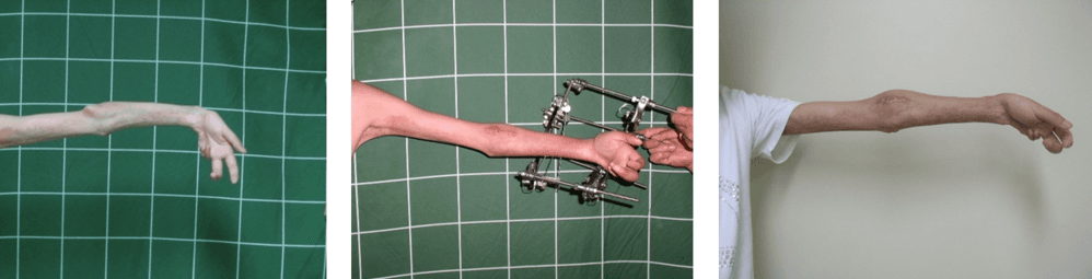 손목관절구축 환자의 교정