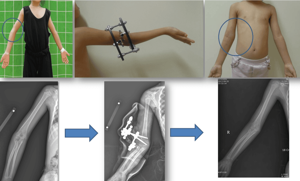 상지의 변형 교정 2