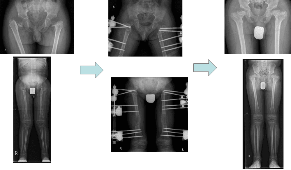 척추골단이형성증환자의 고관절교정 및 대퇴골연장