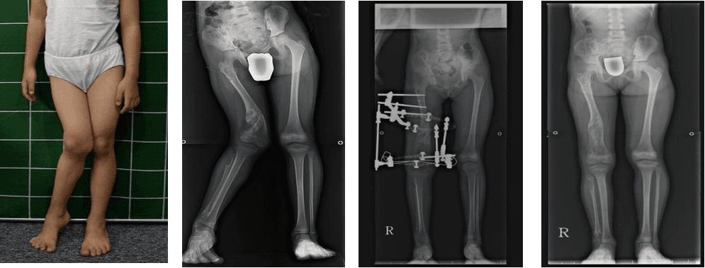 하지변형에 대한 대퇴골교정