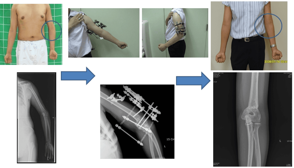 상지의 변형 교정 3