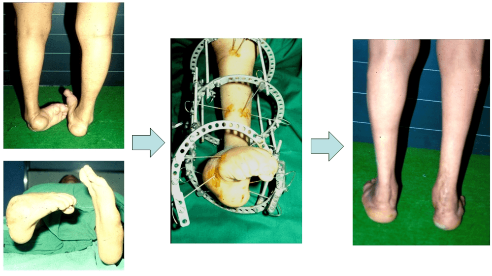 발의 변형에 대한 교정 4