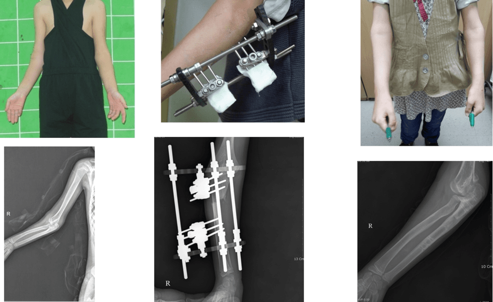 성장판손상을 동반한 골절이후 발생한 변형에 대한 교정