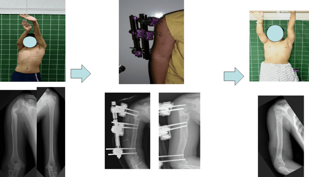 상지단축 및 변형에 대한 연장 및 교정