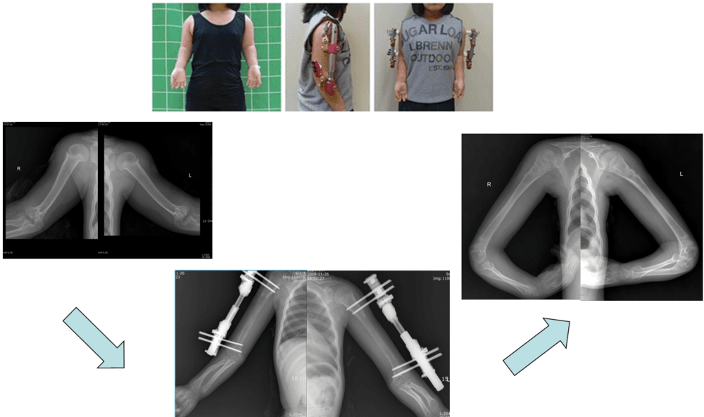 연골무형성증환자에서 상지연장술