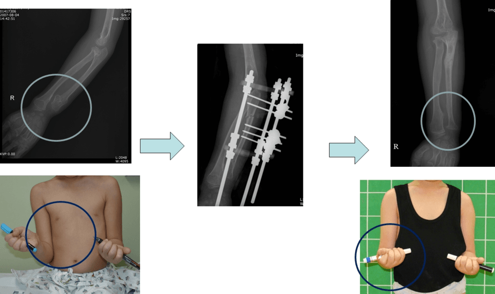 다발성 골연골종환자에서 상지변형 교정과 연장