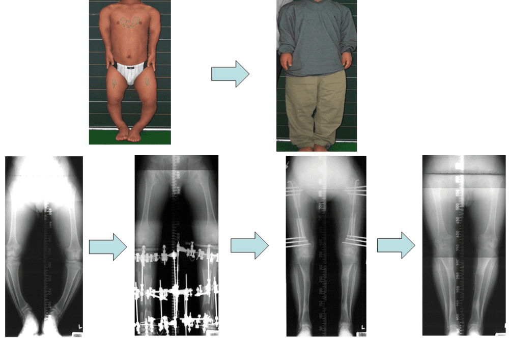 연골무형성증환자의 하지연장