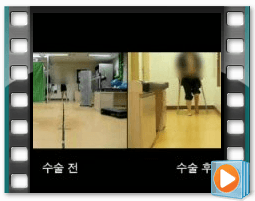 (수술전/후) 보행 2
