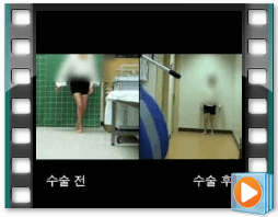 (수술전/후) 보행 3