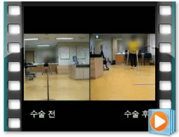 (수술전/후) 보행 5