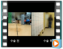 (수술전/후) 보행 6