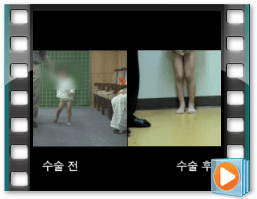 (수술전/후) 보행 7