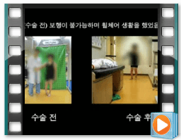 (수술전/후) 보행 8