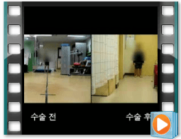 (수술전/후) 보행 9