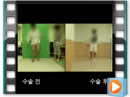 (수술전/후) 보행 10