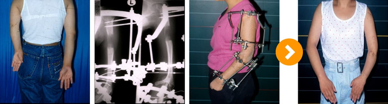 연골 무형성증상지 연장술 10cm