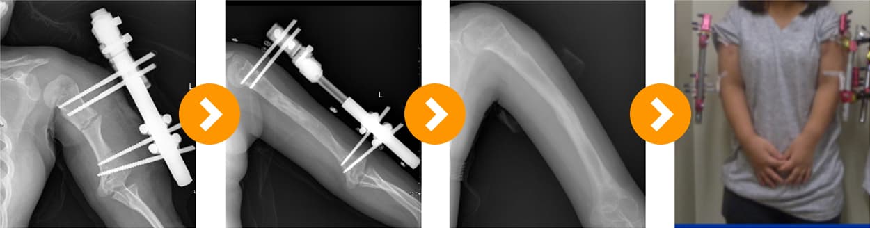 연골 무형성증상지 연장술 10cm