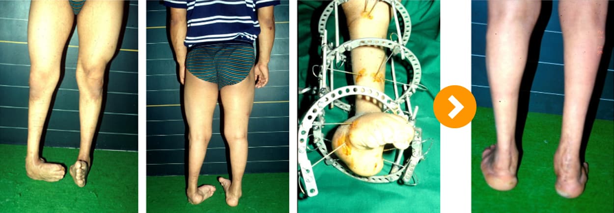 족부 기형 일리자로프 교정술