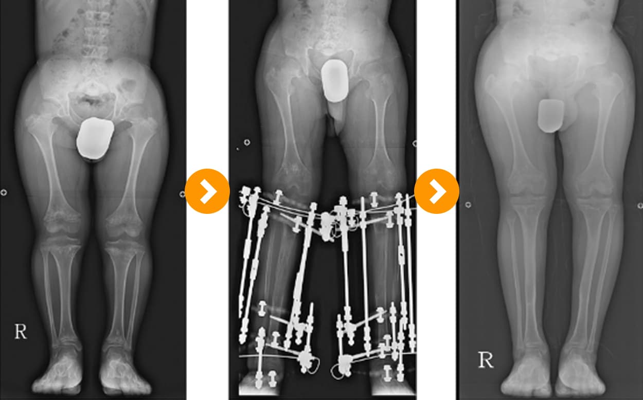 연골 무형성증경골연장술(8 cm) 및 대퇴골 연장술(8 cm)