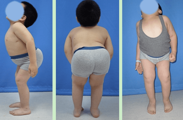 공지 밖으로 휜 다리의 교정