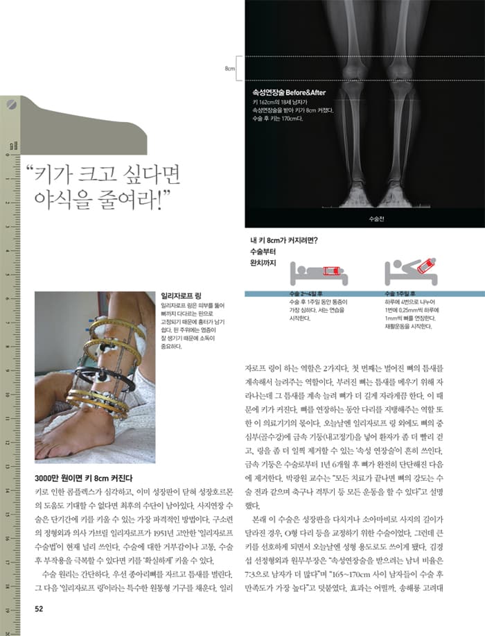 사지연장술 안내 - 인포그래픽 5