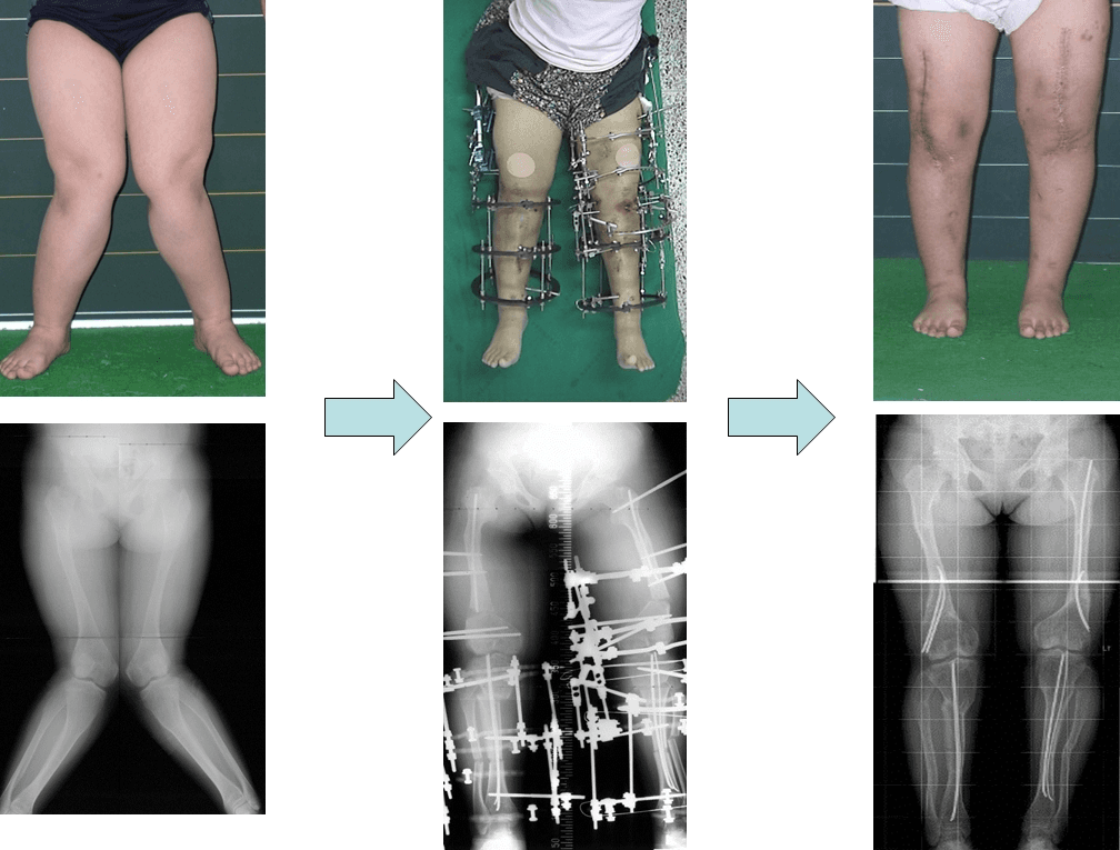 Notice: Correction of Bowlegs