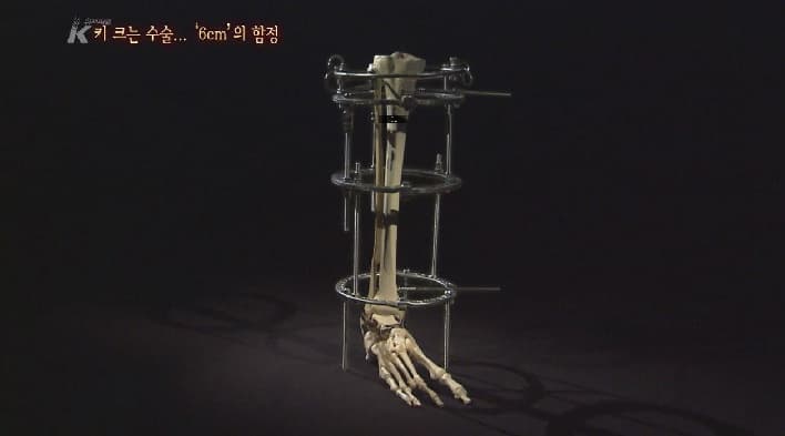 키 크는 수술 “6cm의 함정”